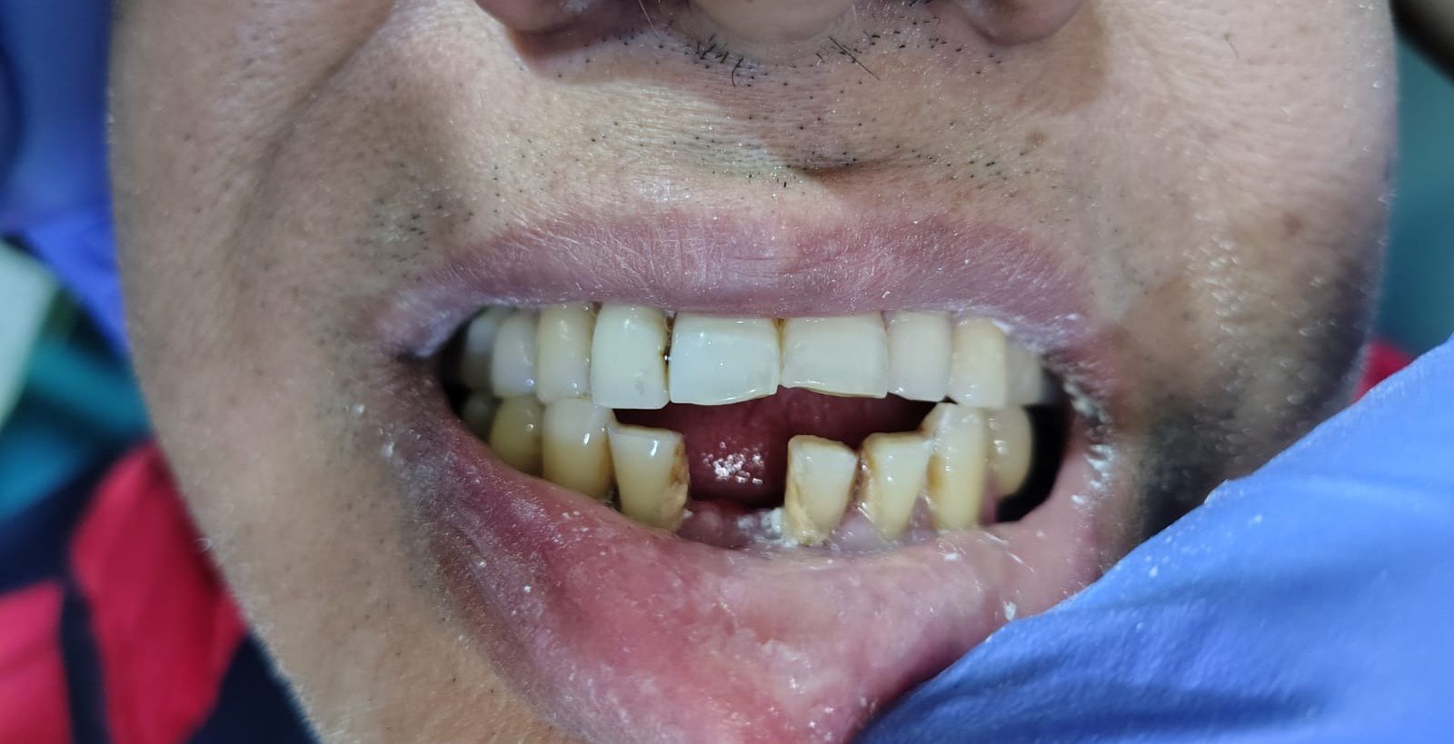 Before dental implant treatment at Bhati Dental Clinic